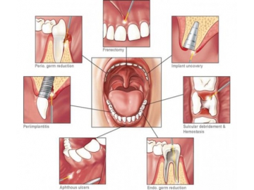 Eliminación de Varices o Arañitas