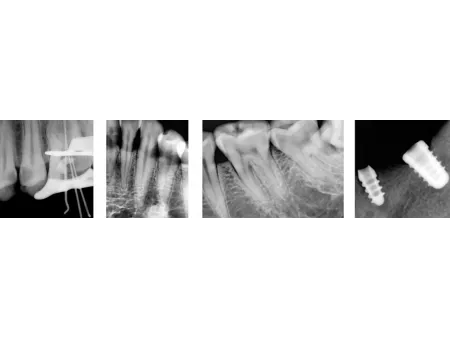Equipo de Rayos X Dental Portátil