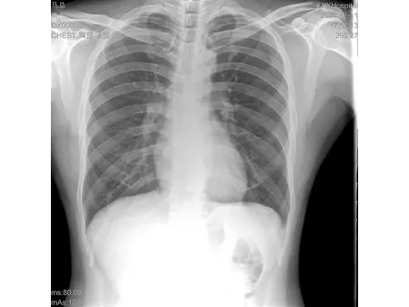 Equipo de Rayos X, Portátil MINI